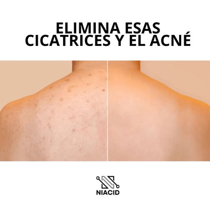 Niacid |elimina acné y cicatrices de espalda y cara