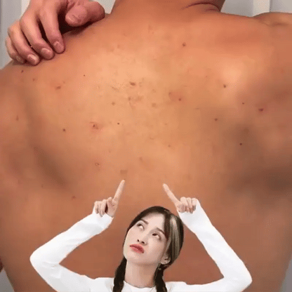 NIACID® LIBERA TU ESPALDA DE MARCAS Y BROTES